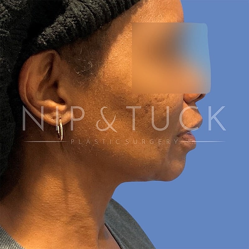 Pdo Threads Before & After