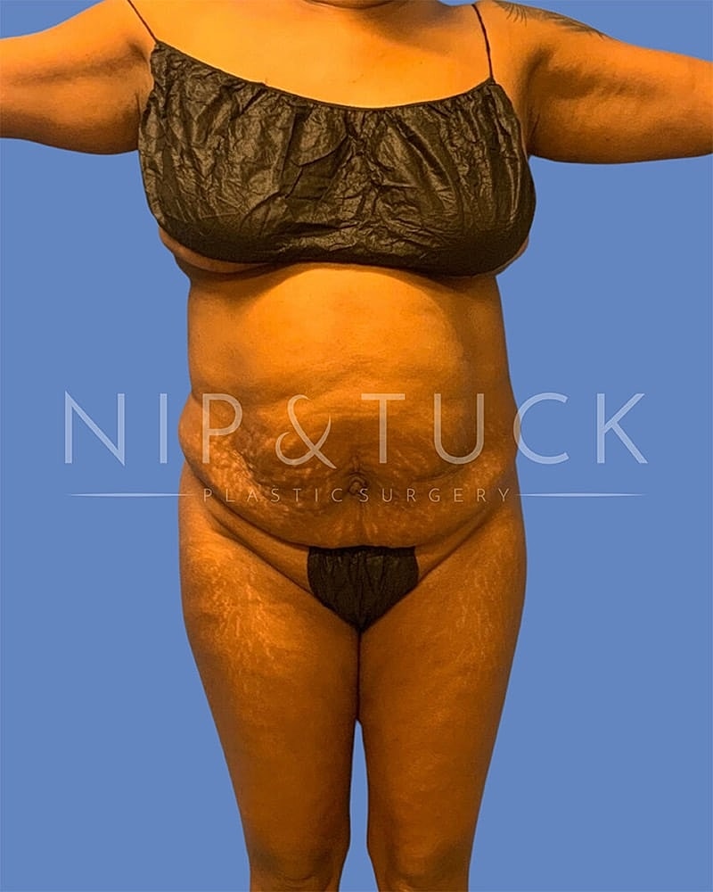 Abdominoplasty Before & After