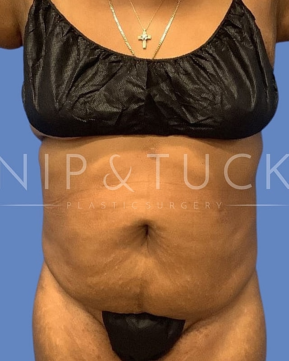 Individual showcasing body after plastic surgery.