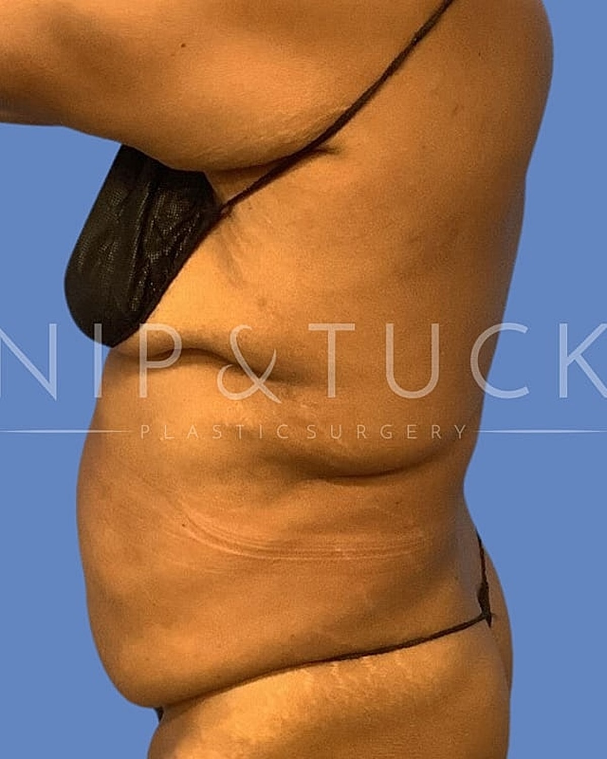Abdominoplasty Before & After