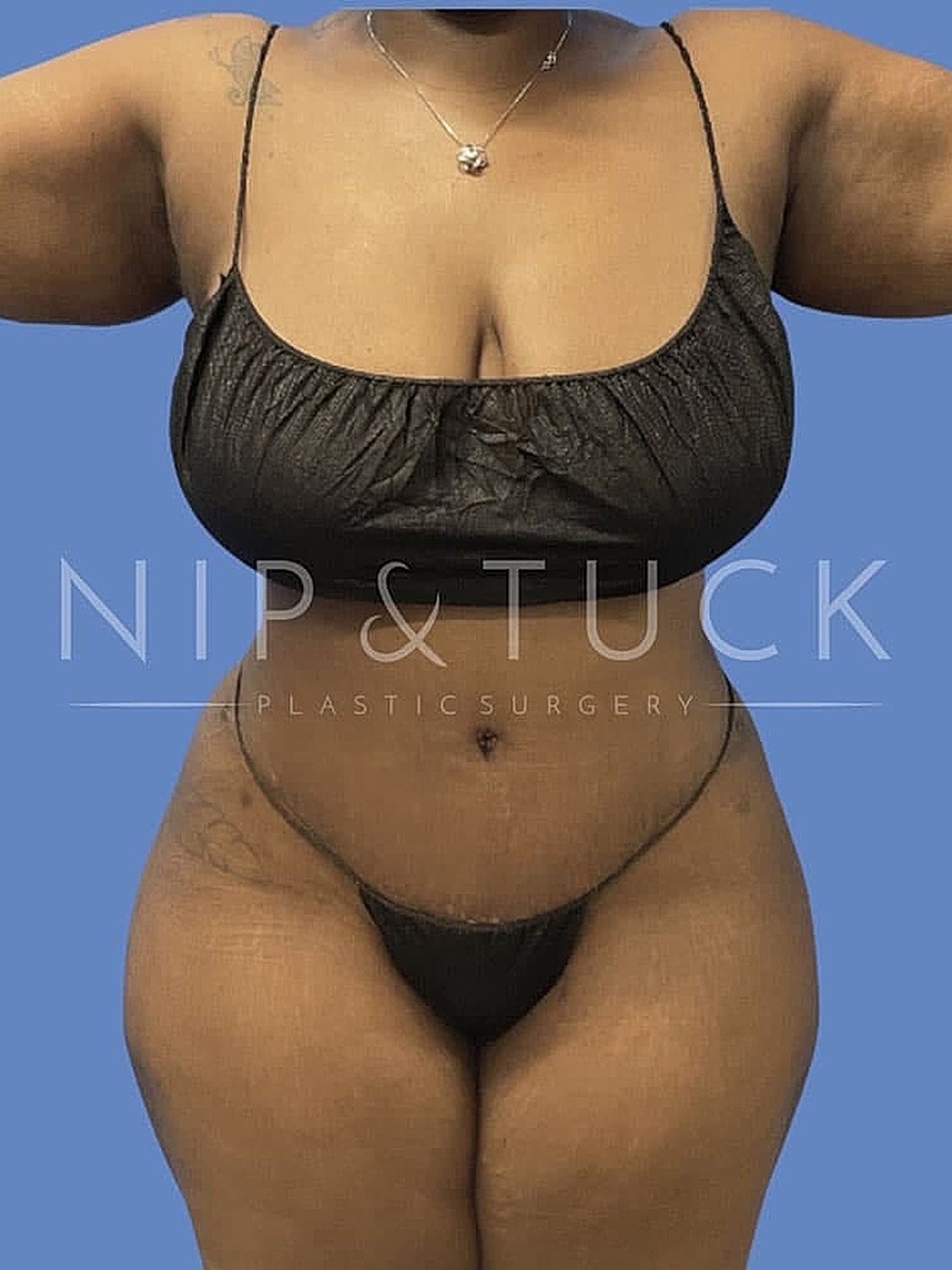 Abdominoplasty Before & After