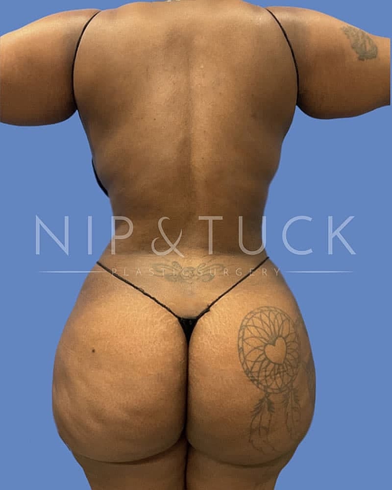 Abdominoplasty Before & After