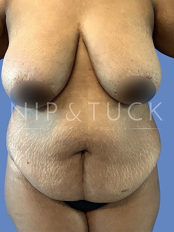 Abdominoplasty Before & After