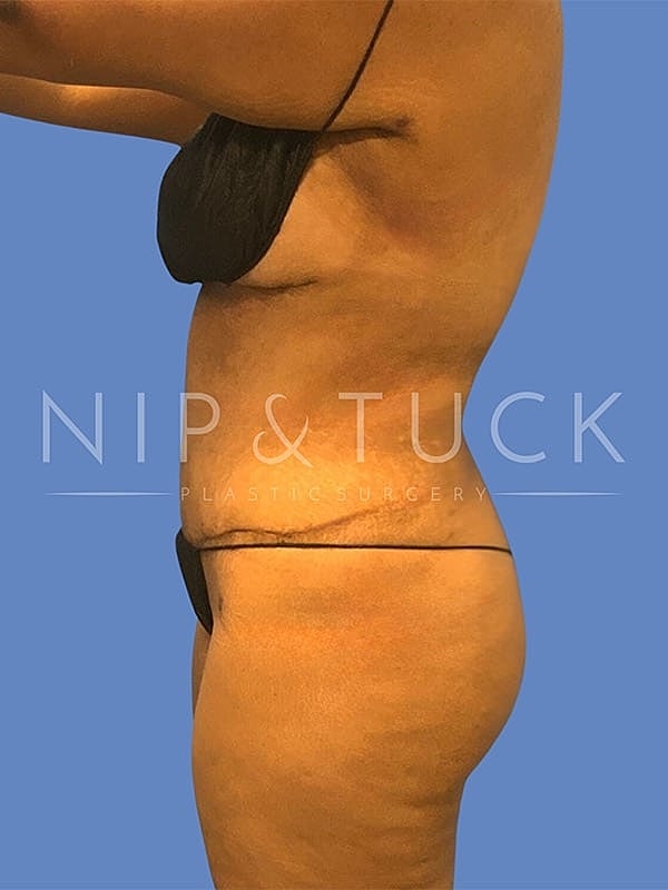 Abdominoplasty Before & After