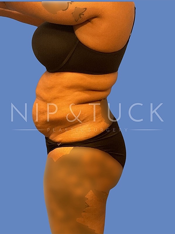 Abdominoplasty Before & After