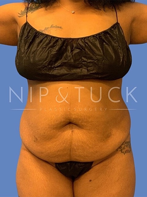 Abdominoplasty Before & After