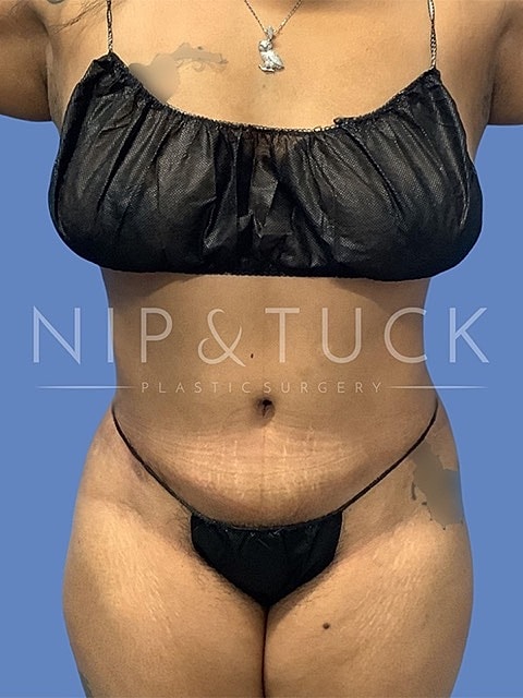 Abdominoplasty Before & After
