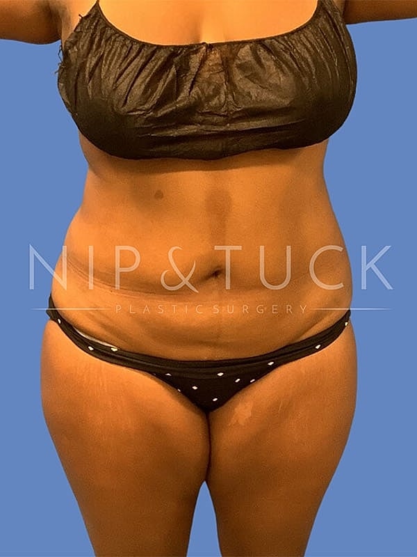 Abdominoplasty Before & After