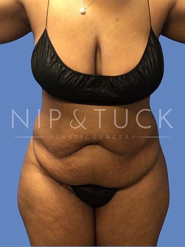 Abdominoplasty Before & After