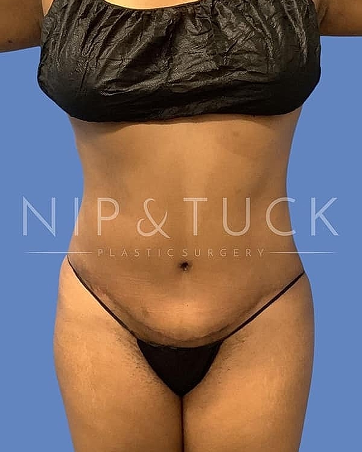 Abdominoplasty Before & After
