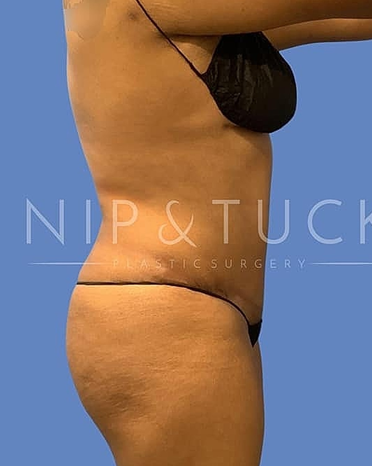 Side view of body, showcasing plastic surgery results.
