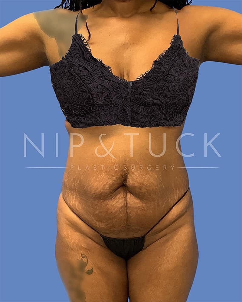 Abdominoplasty Before & After