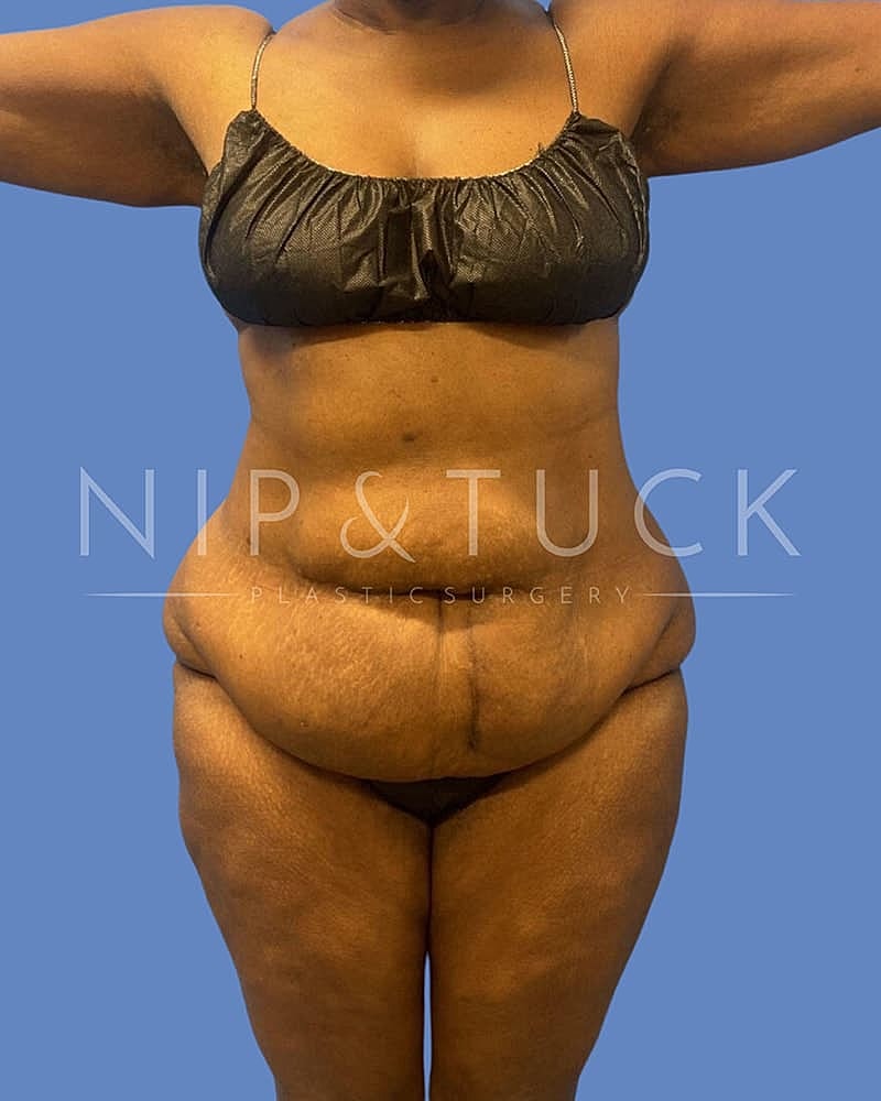 Abdominoplasty Before & After