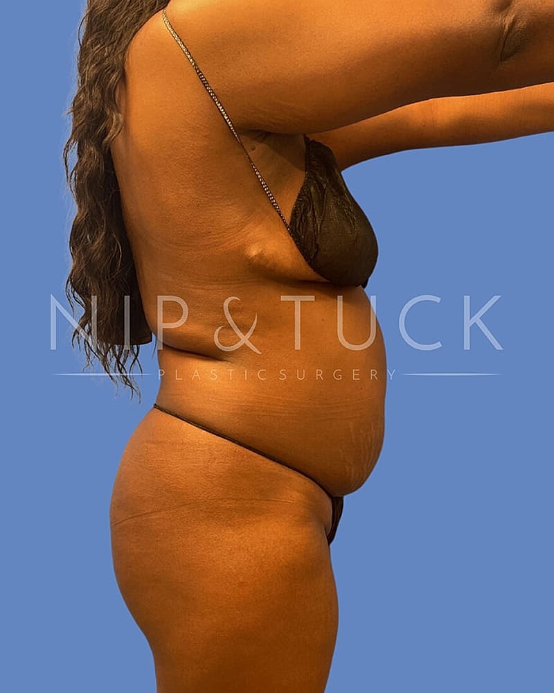 Abdominoplasty Before & After