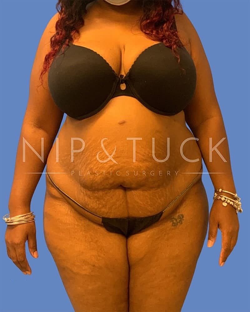 Abdominoplasty Before & After