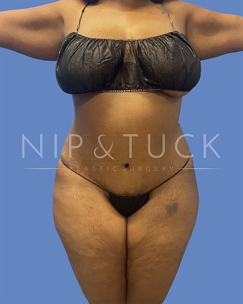 Abdominoplasty Before & After