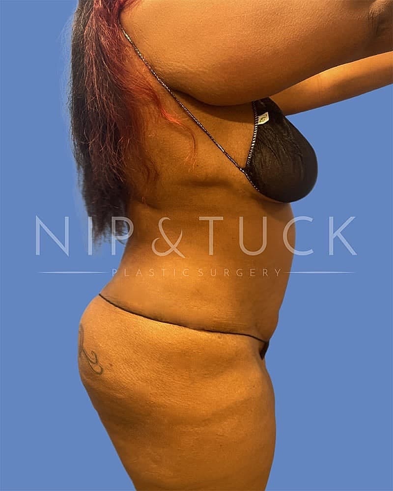 Abdominoplasty Before & After