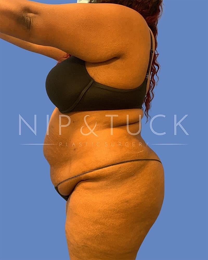 Abdominoplasty Before & After