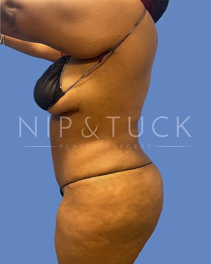 Abdominoplasty Before & After
