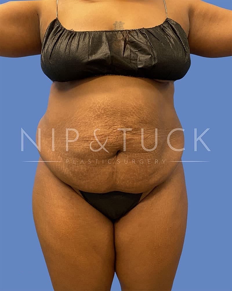 Abdominoplasty Before & After