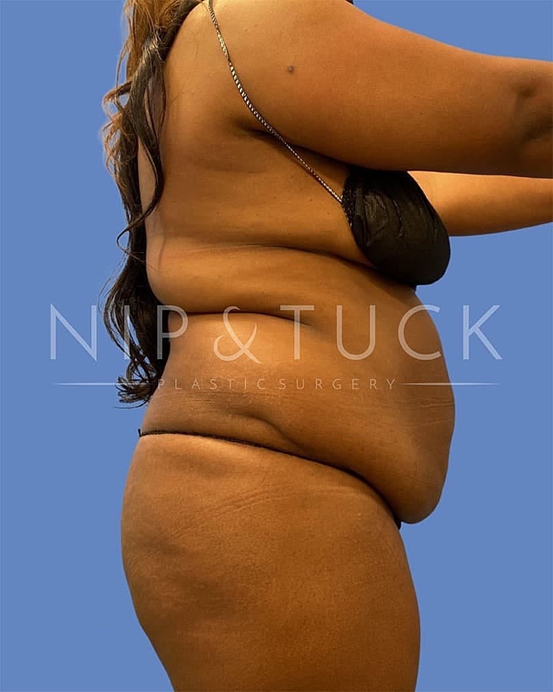 Abdominoplasty Before & After