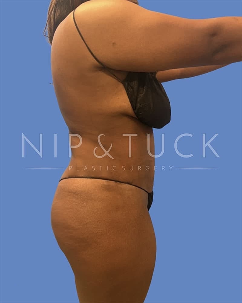 Abdominoplasty Before & After