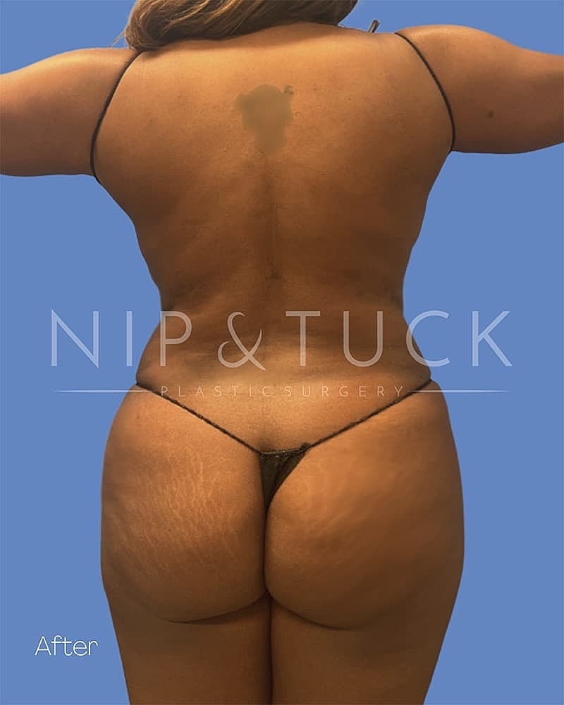 Abdominoplasty Before & After