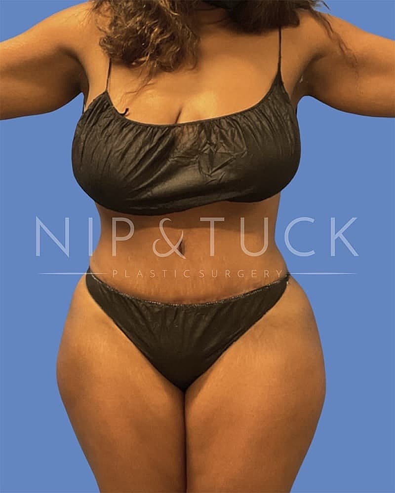 Abdominoplasty Before & After