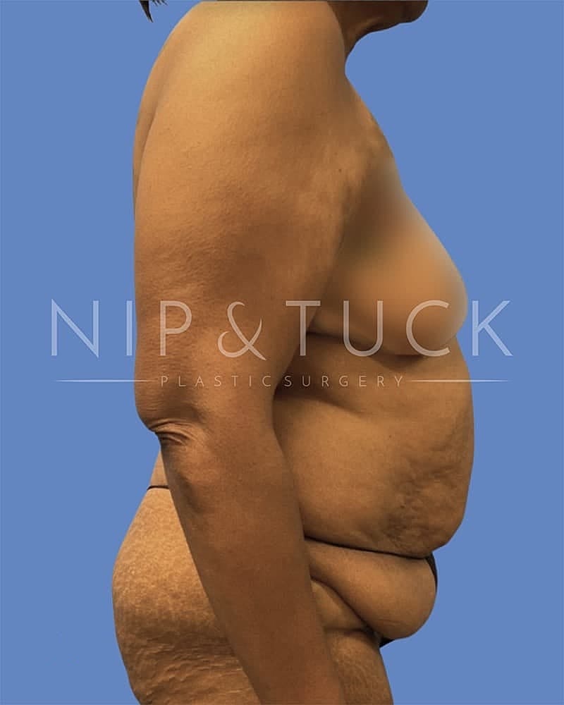 Abdominoplasty Before & After