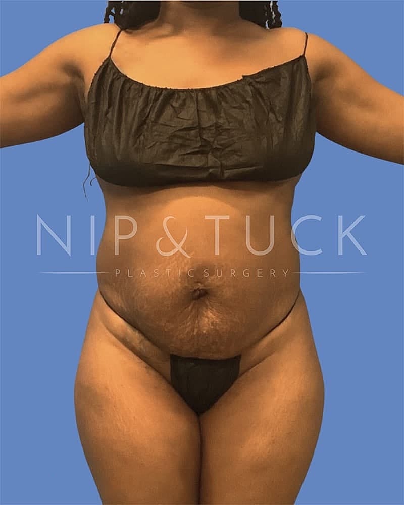 Abdominoplasty Before & After