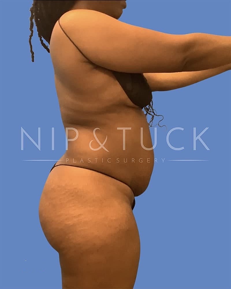 Abdominoplasty Before & After