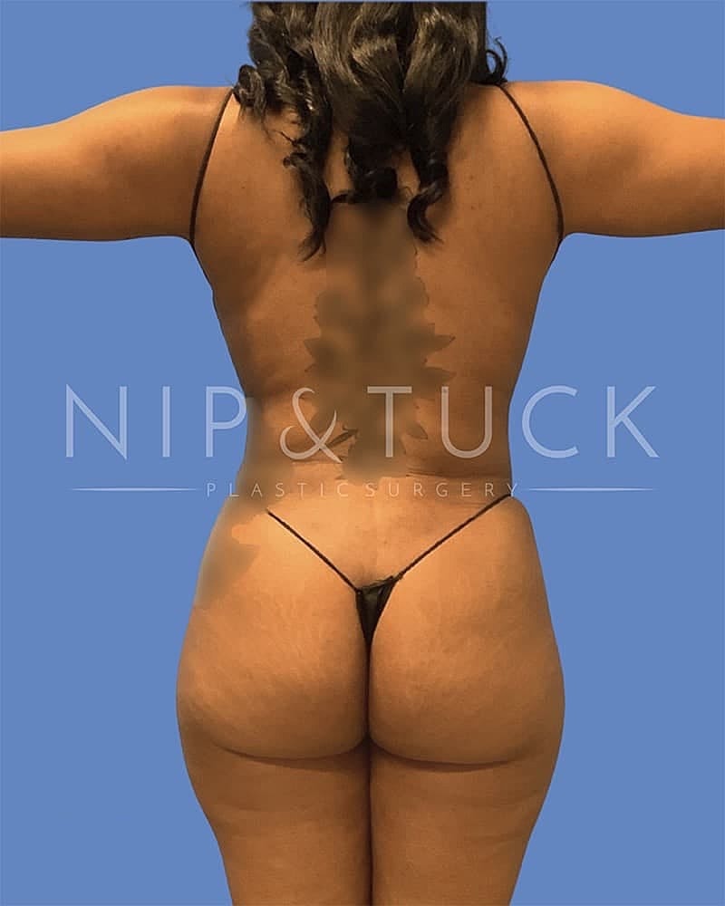Abdominoplasty Before & After