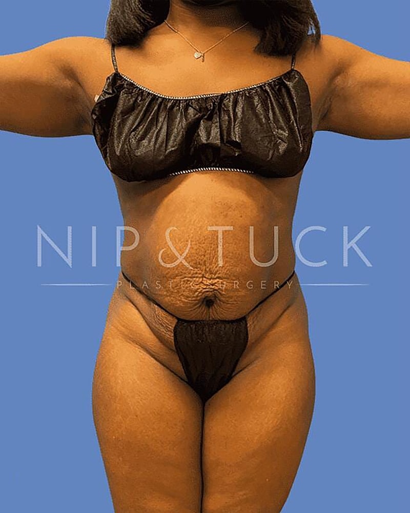 Abdominoplasty Before & After