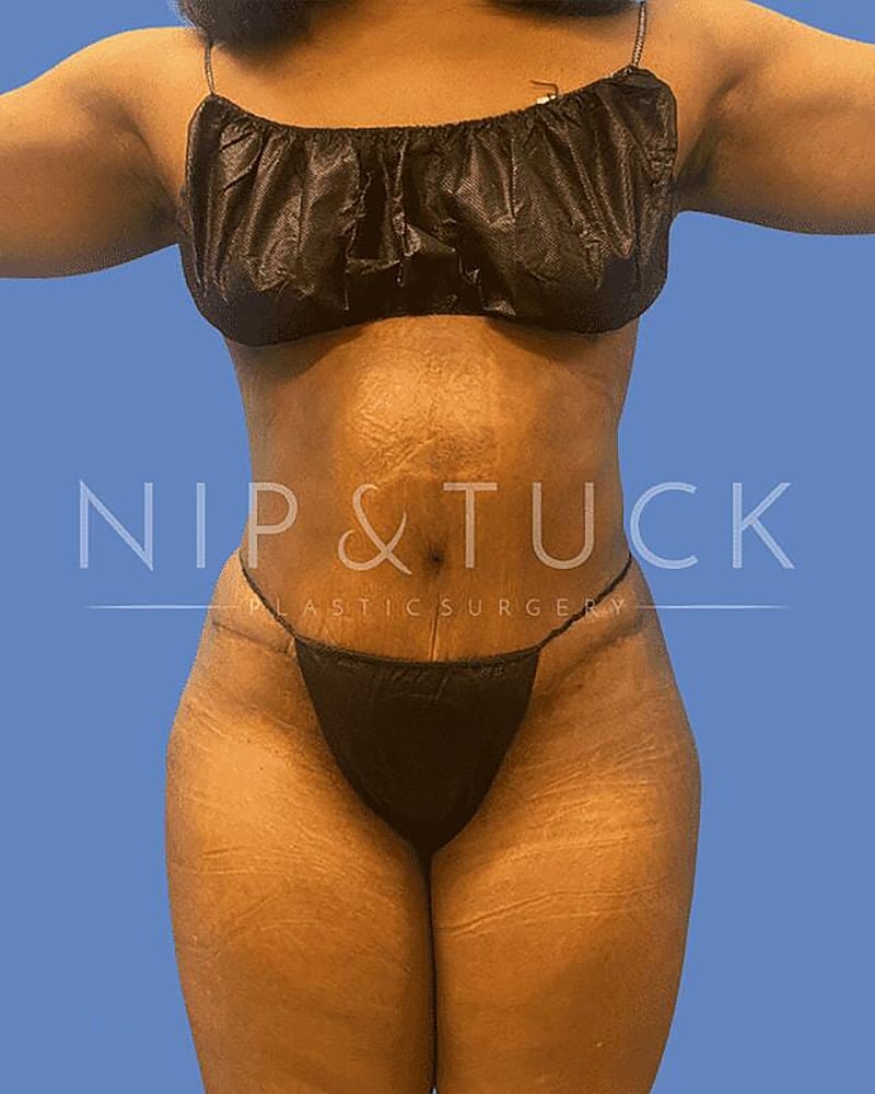 Abdominoplasty Before & After