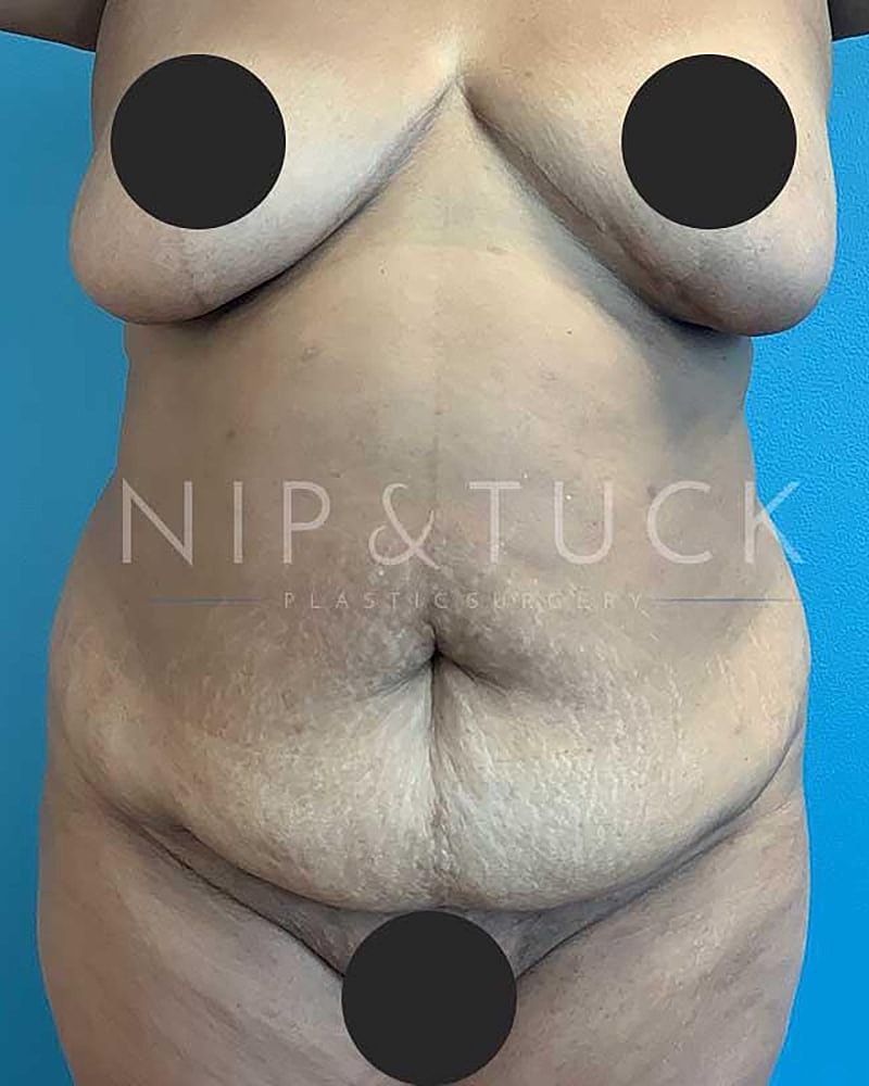 Abdominoplasty Before & After