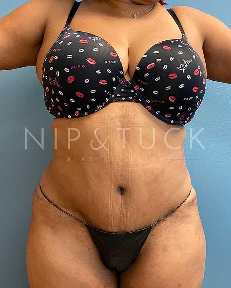 Abdominoplasty Before & After
