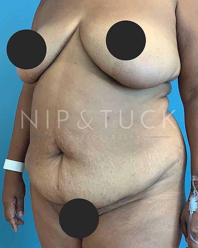 Abdominoplasty Before & After