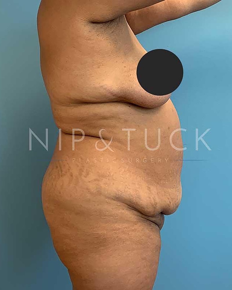 Abdominoplasty Before & After