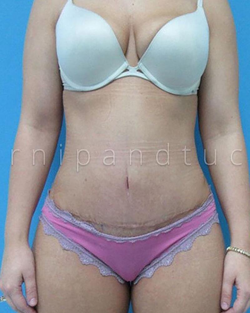 Abdominoplasty Before & After