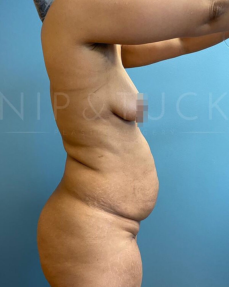 Abdominoplasty Before & After
