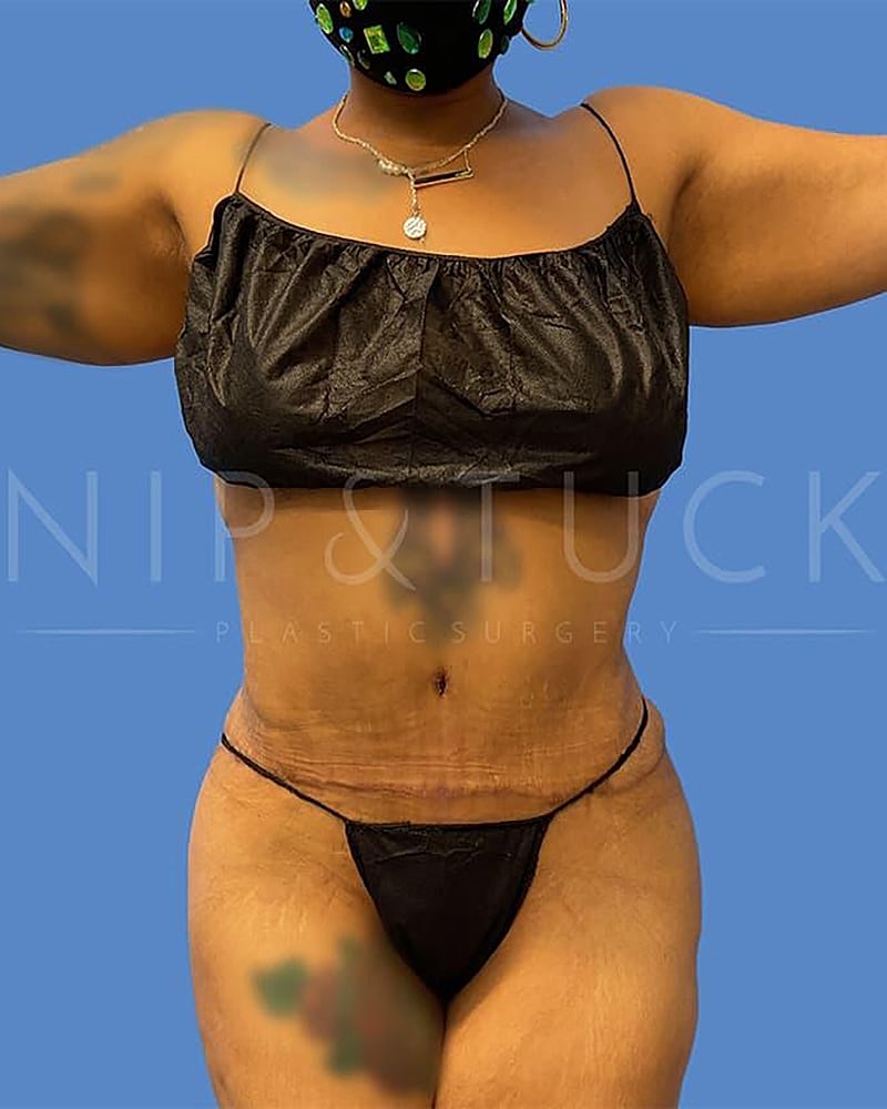 Abdominoplasty Before & After