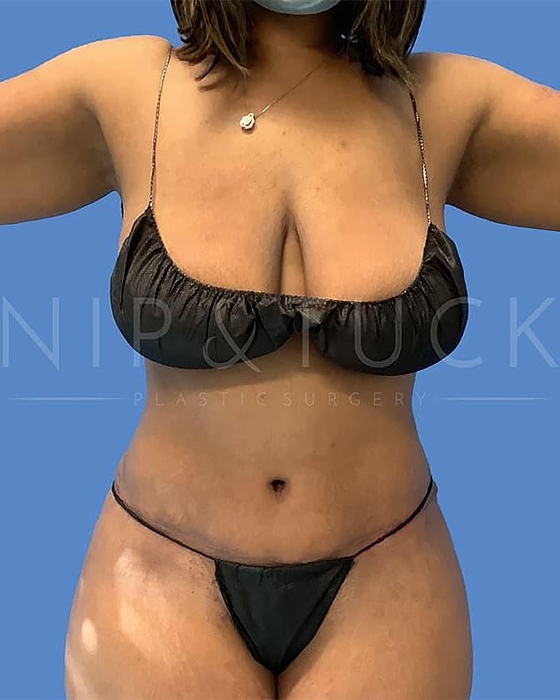 Abdominoplasty Before & After