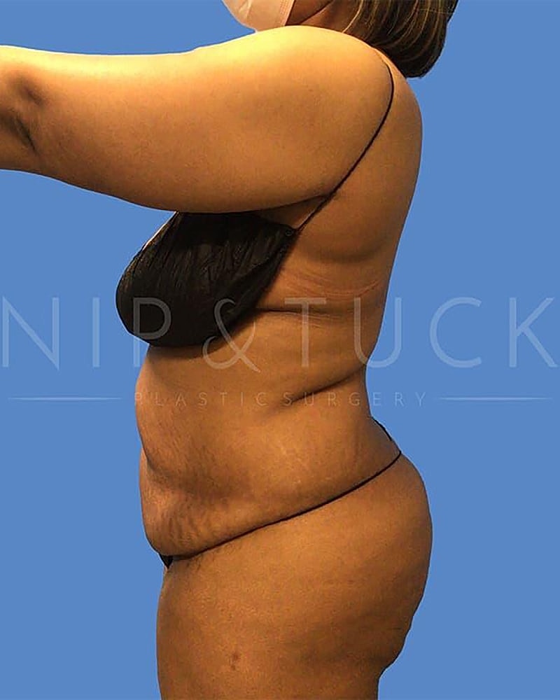 Abdominoplasty Before & After