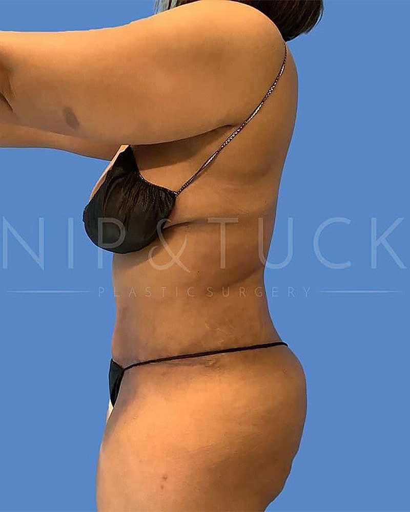 Abdominoplasty Before & After