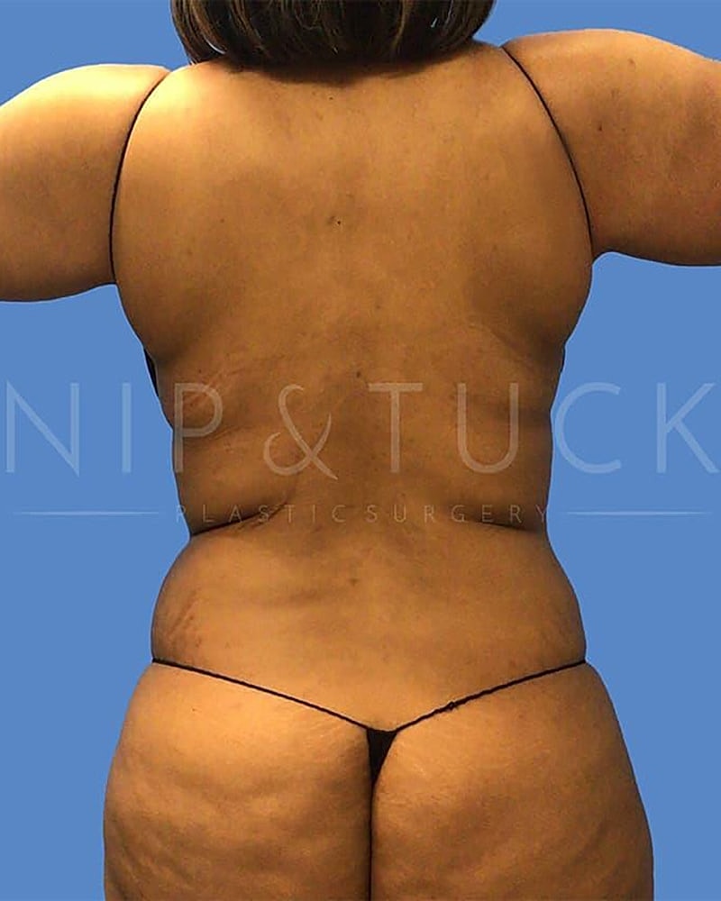 Abdominoplasty Before & After