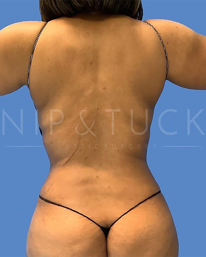 Abdominoplasty Before & After