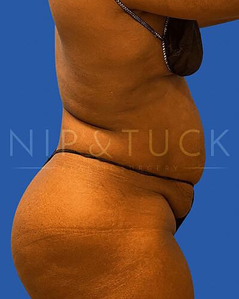 Abdominoplasty Before & After