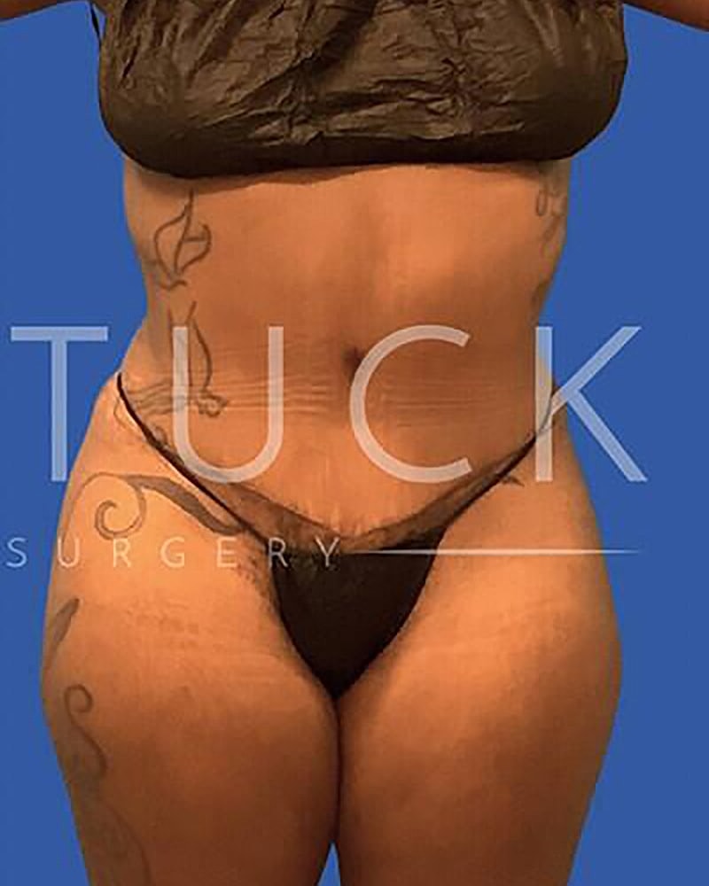 Abdominoplasty Before & After