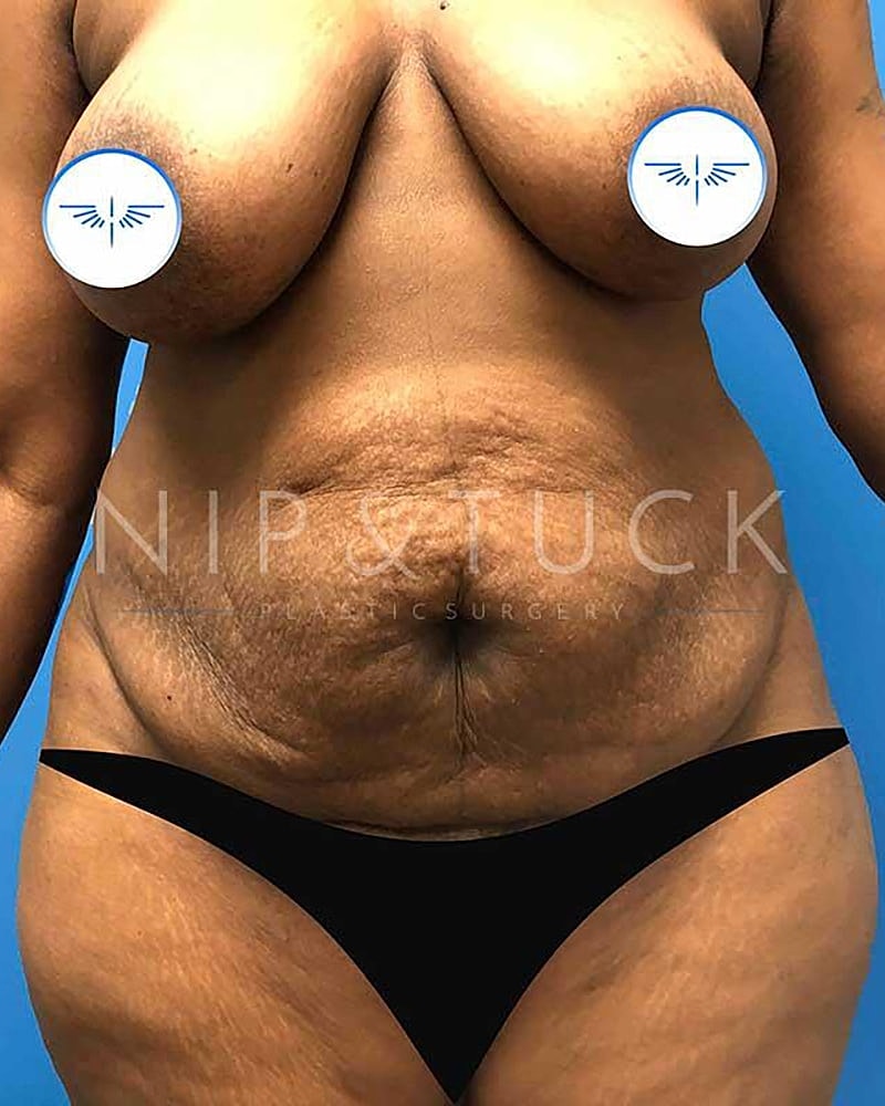 Abdominoplasty Before & After