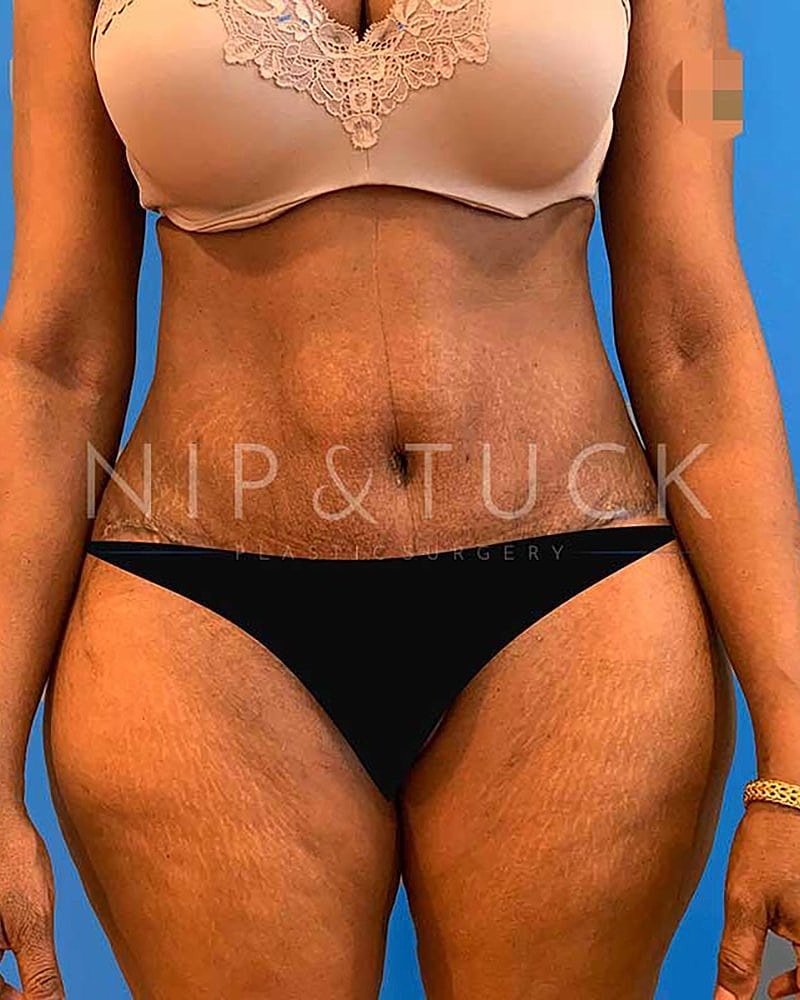 Abdominoplasty Before & After